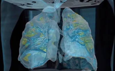 A 3D image illustrating how COVID-19 can affect human lungs